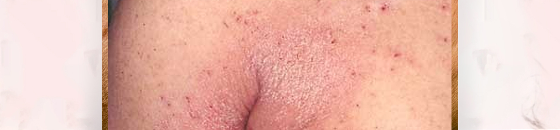 Best Scabies Treatment Clinic in Bhubaneswar