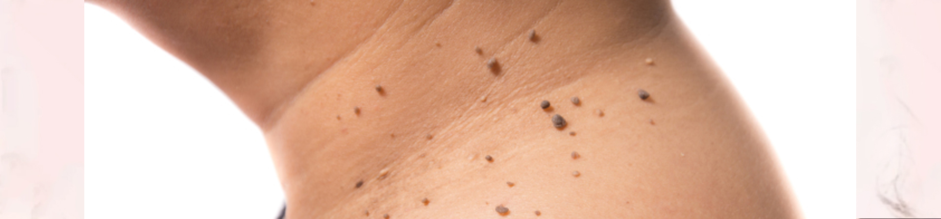 Best Skin tag removal clinic near AIIMS Hospital