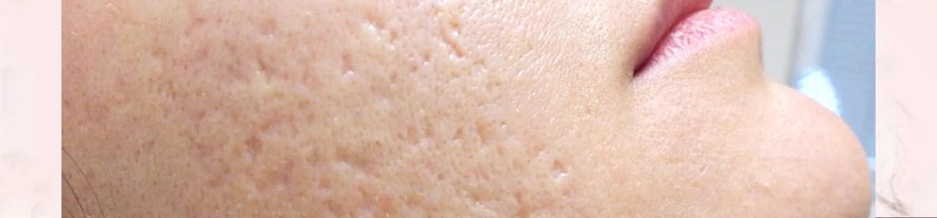 best skin pores treatment clinic in odisha