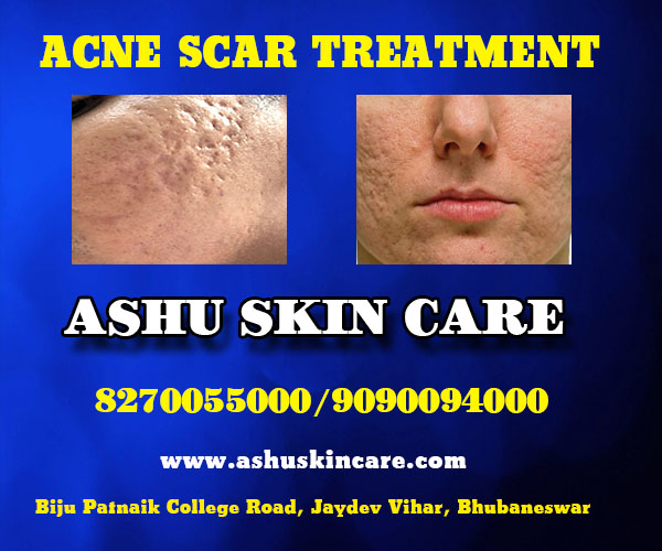 best acne doctor near me