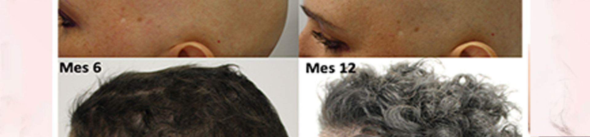 Best Alopecia Treatment Clinic near me