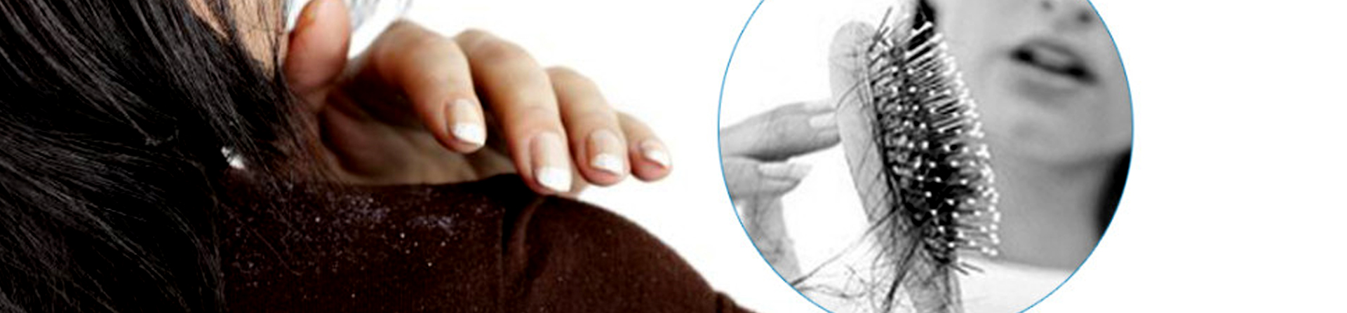 Best Dandruff Treatment Clinic near me