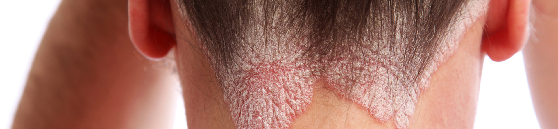 Best Psoriasis of Scalp Treatment Clinic near Capital Hospital