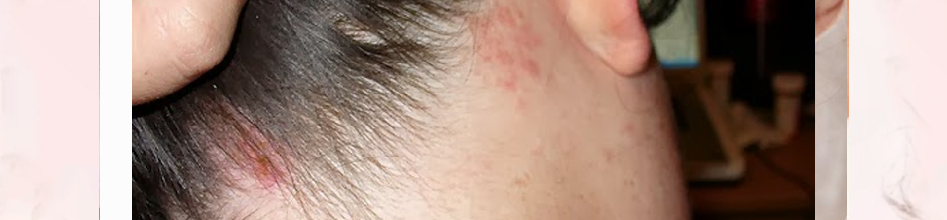 Best Scalp Infection Treatment Clinic near Apollo Hospital