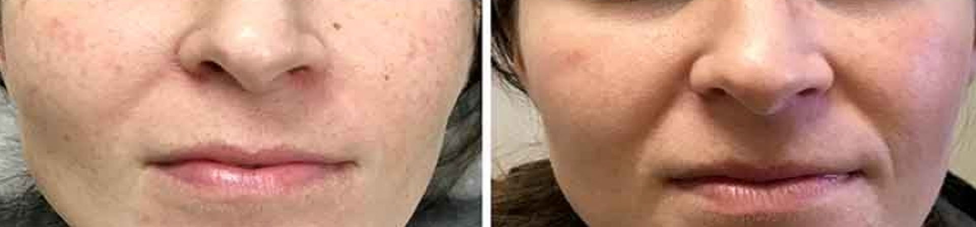 Best Skin tag Removal Clinic in odisha