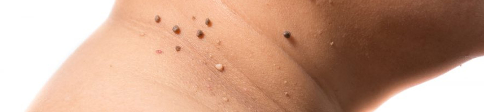 Best Skin Tag Treatment Clinic in Bhubaneswar