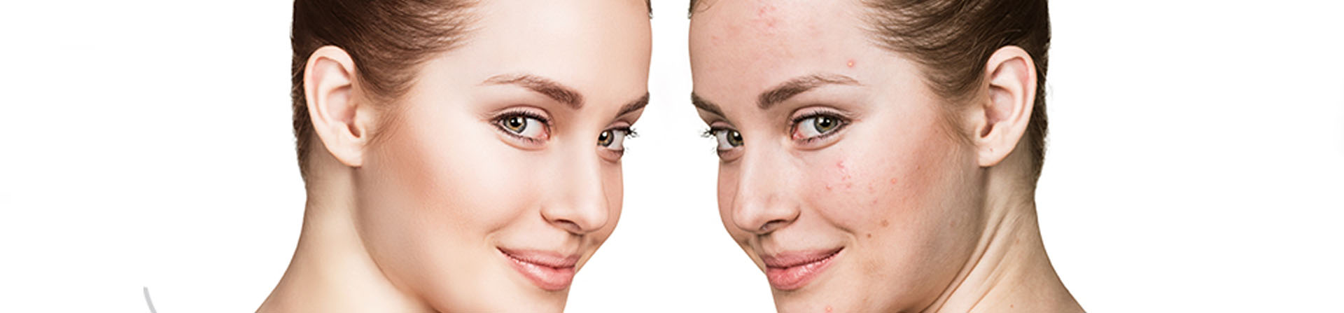 Best Acne Treatment Clinic in Odisha