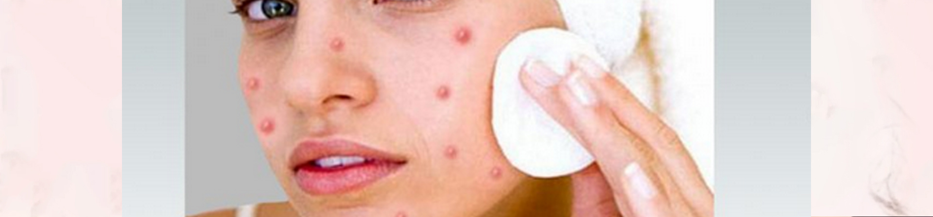 Best Pimples Treatment Clinic in Odisha
