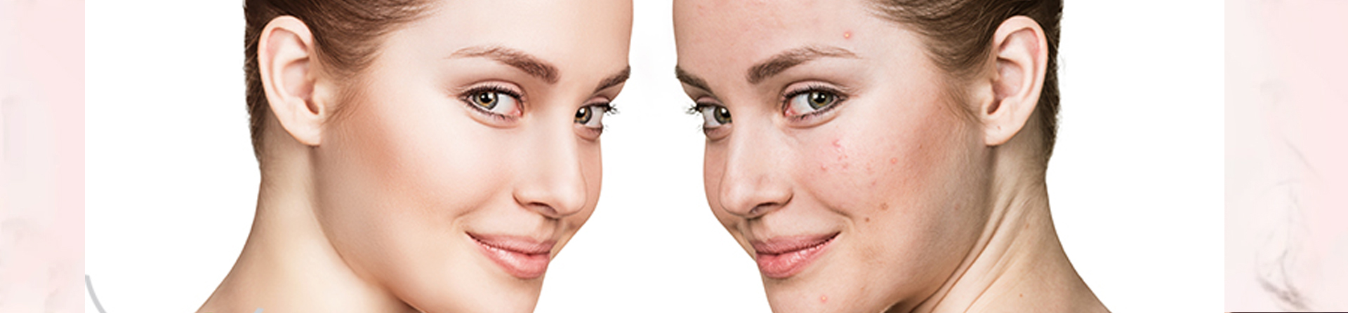 best acne treatment clinic in bhubaneswar