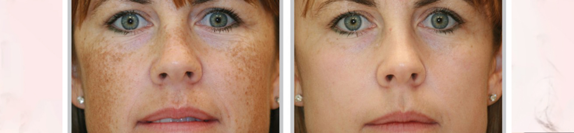 best melasma treatment clinic in odisha