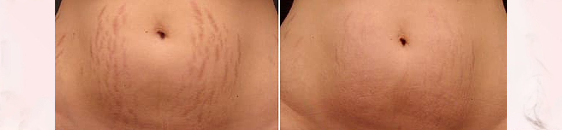 Top Stretch marks treatment clinic in bhubaneswar