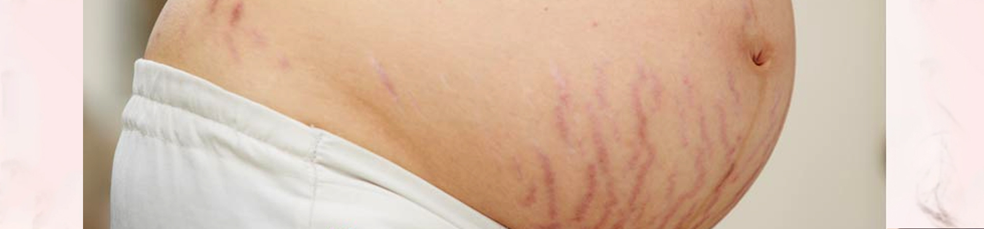 best pregnancy stretch marks treatment clinic in bhubaneswar