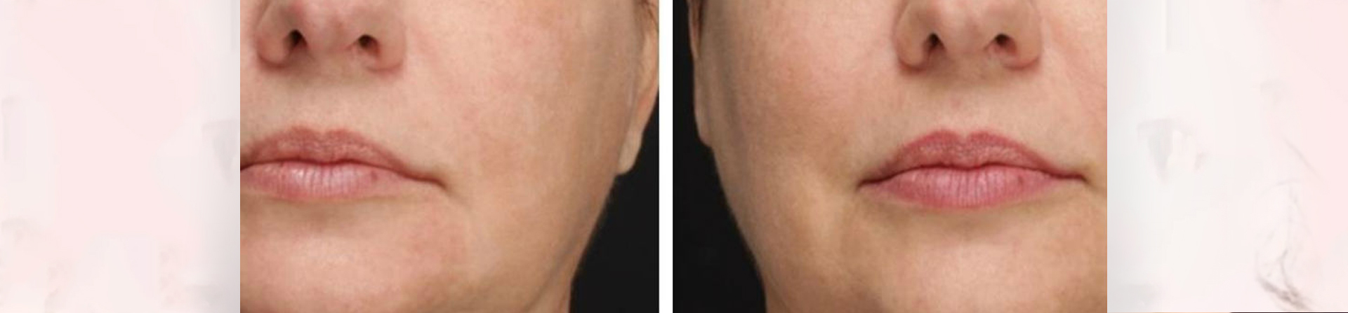 Best Skin Tightening Treatment Clinic in Bhubaneswar